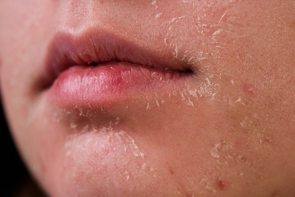 علائم پوست خشک چیست؟ دلایل، روش پیشگیری و نحوه درمان