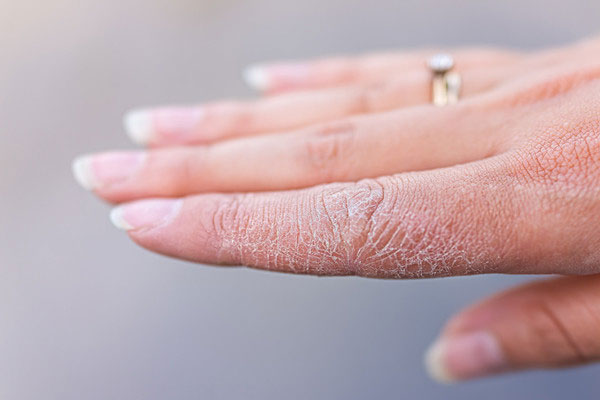 بررسی دلایل خشکی پوست | درمان و پیشگیری